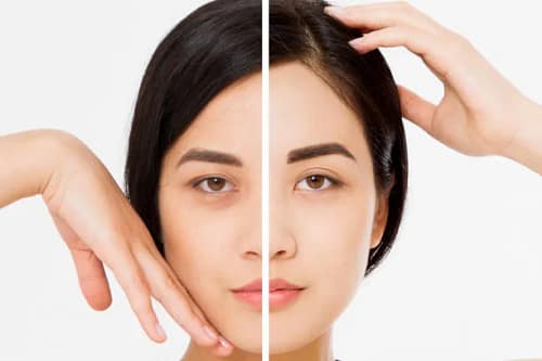 Reduce dark circles naturally