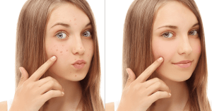 Face Packs for Pimples by Advik Ayurveda